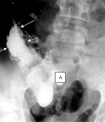 Ultrasound-Guided Percutaneous Drainage of Abdominal Abscess in a Patient With Crohn's Disease: A Case Report